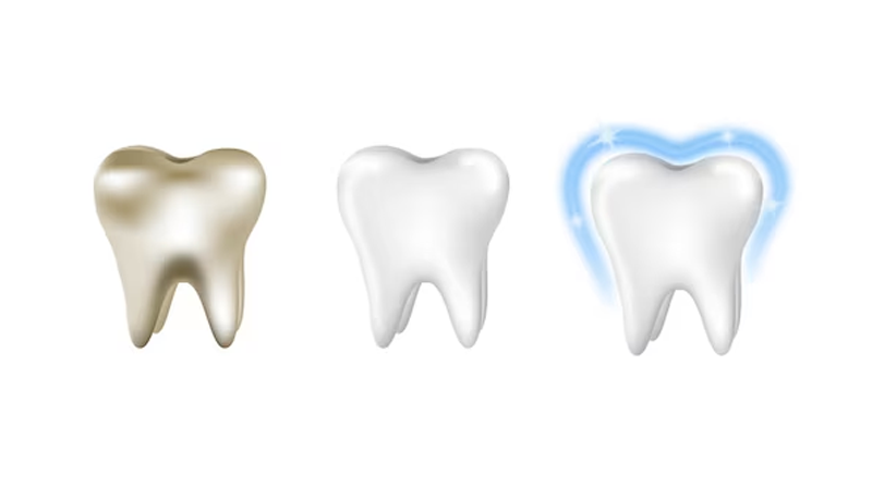 Why Teeth Whitening