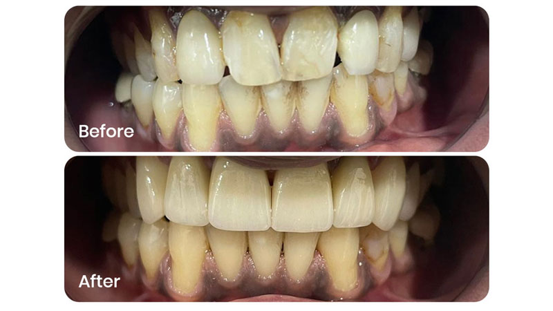 smile designing can boost confidence