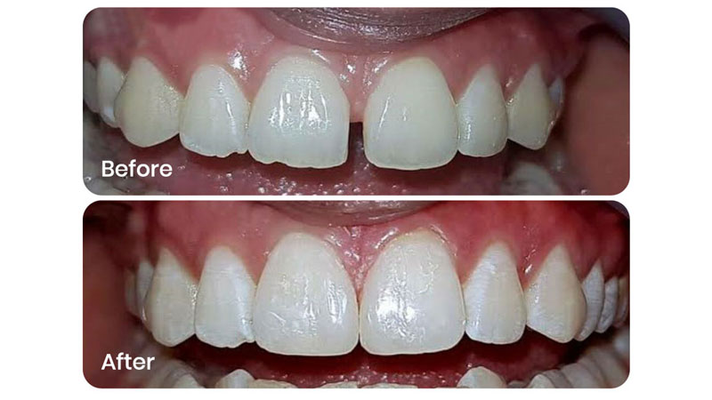 before after image of managing front teeth gaps done by dr. chaitali at the smile spa dental clinic mumbai