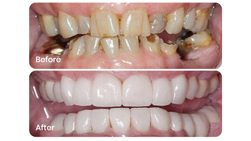 Full Mouth Rehabilitation