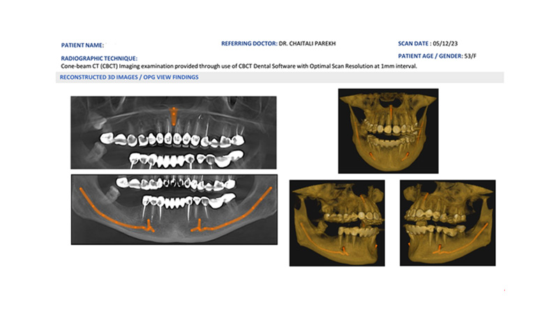 CBCT image of patient at the smile spa dental clinic Juhu. CBCT provides clear 3D visualizations of bone, nerve pathways, and soft tissue
