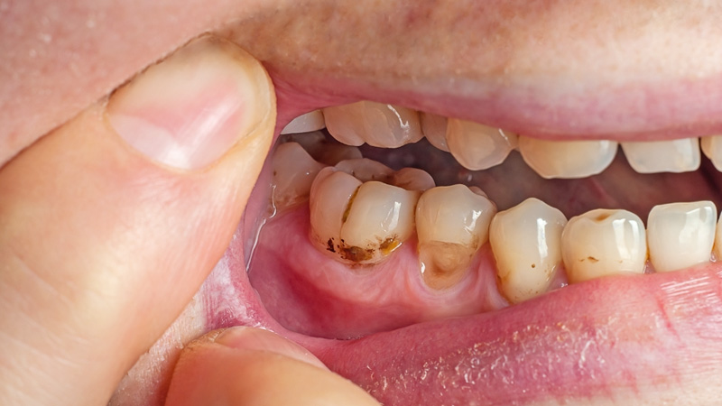 Inadequate brushing and flossing allow plaque and stains to build up.