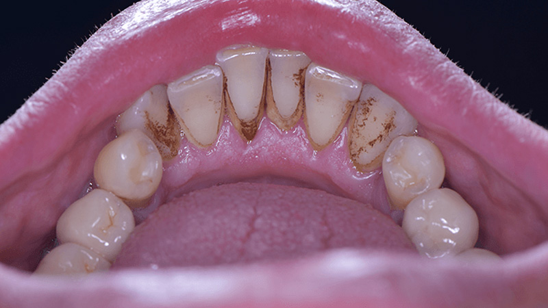 Smoking or chewing tobacco leads to stubborn brown or yellow stains
                        
