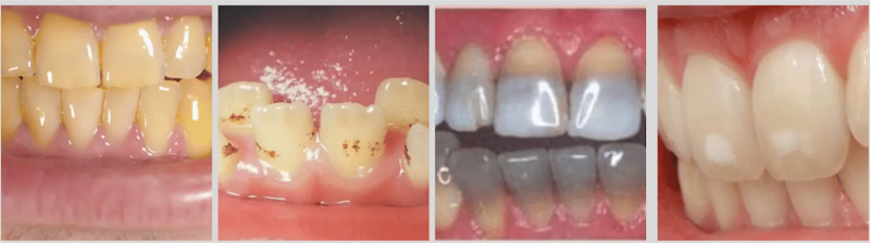 teeth discoloration due to internal trauma, metal fillings, or tooth death, etc.
