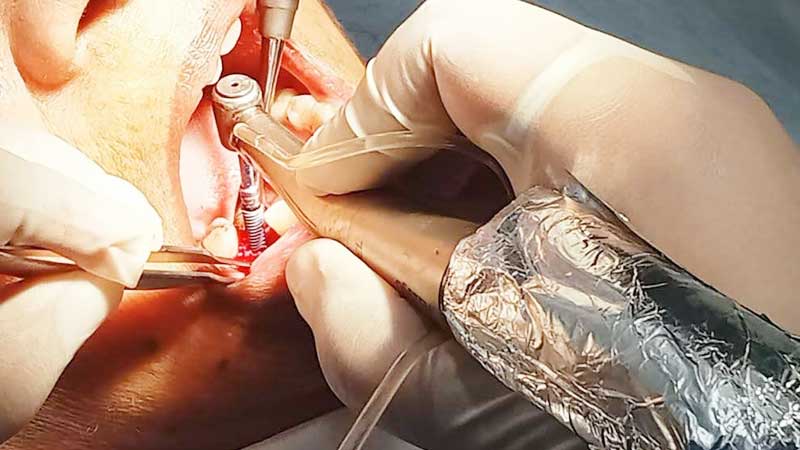 Placement of implant in the patient mouth, carefully performed with precision and care by Dr. Chaitali