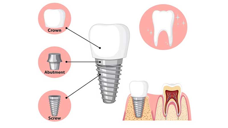 image showing Dental Implants basic parts like screw, abutment, crown