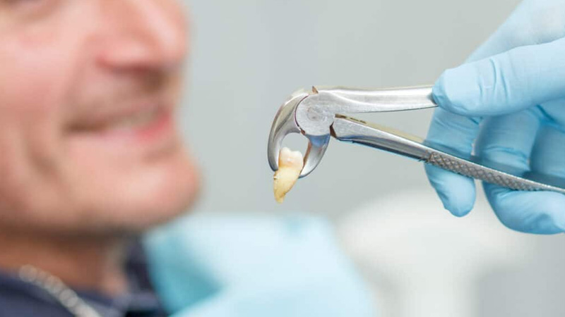 Tooth Removal Near Me