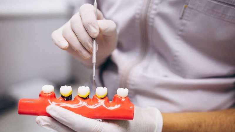 dental crowns and bridges done by the smile spa at vile parle west mumbai