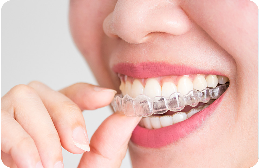  Invisalign ® Clear Braces