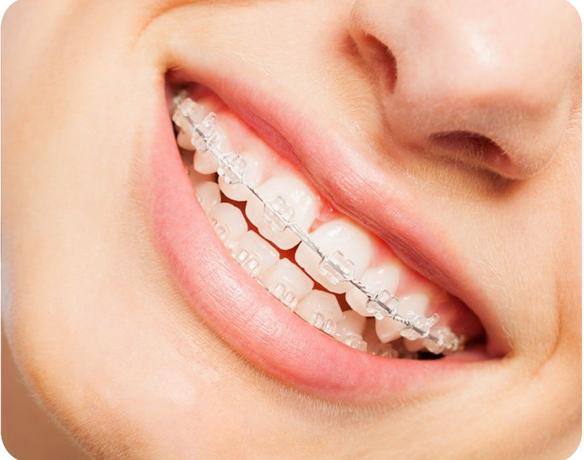 Orthodontic braces are worn at any age and are used to correct a variety of mal-alignment conditions