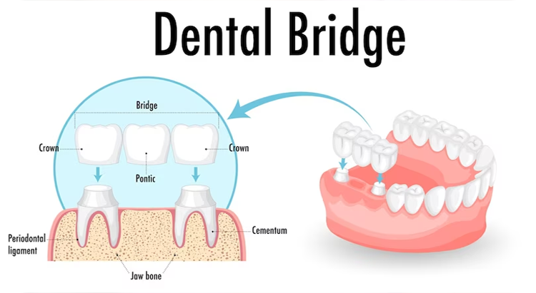 Dental bridge procedure 