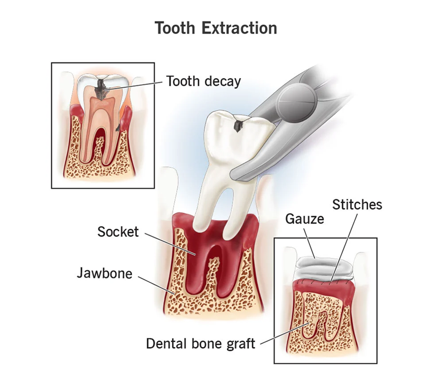 tooth extraction procedure photo