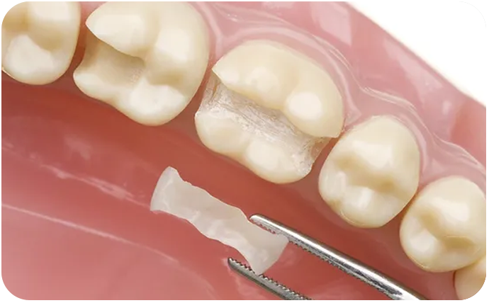  Dental filling materials are porcelain or tooth coloured plastic and materials like composite resin fillings used