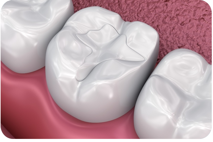 Tooth photo after dental filling treatment 
