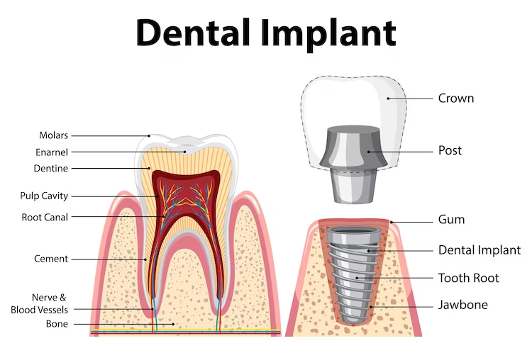 Diagram of the various parts and procedure of dental implants treatment