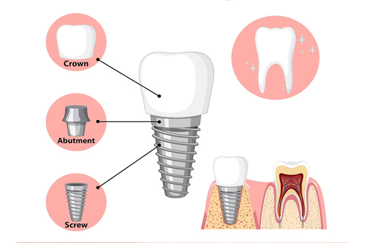 Photo of dental implant procedure