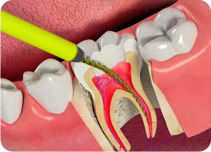 If the pulp or soft tissue inside the root canal is inflamed or infected, you might be in need of root canal treatment.