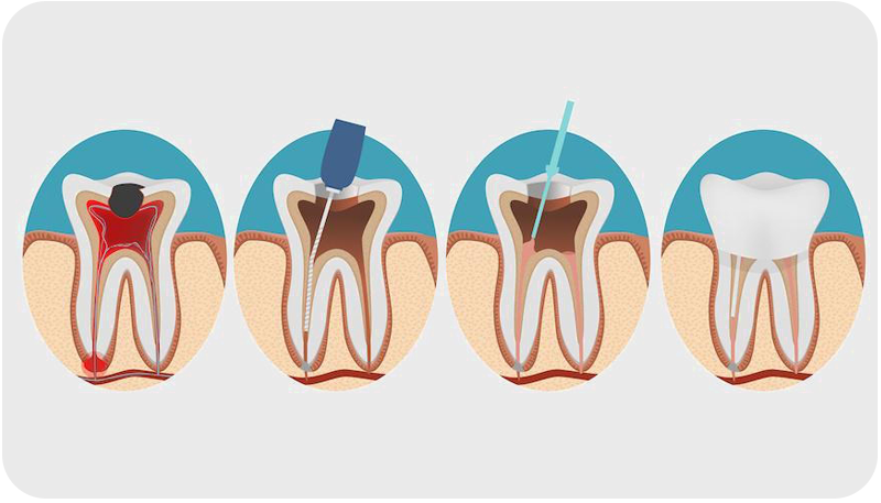 Root Canal Treatment is a good option as it is a restorative dental procedure. It helps repair and save a badly damaged or infected tooth instead of removing it. 