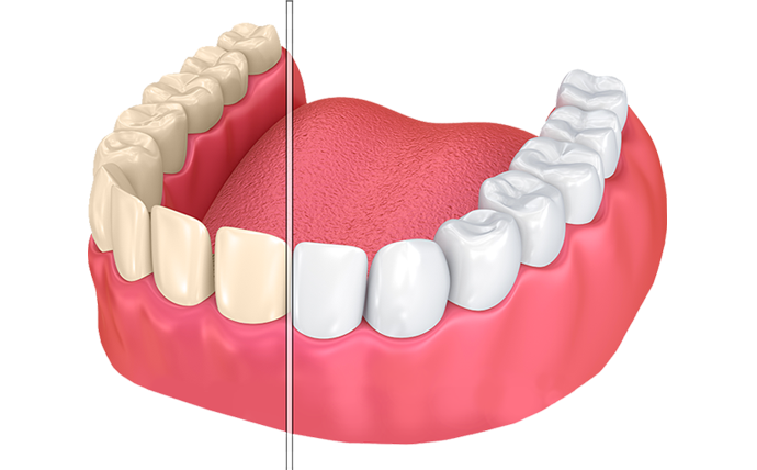 How teeth looks before and after of tooth whitening treatment