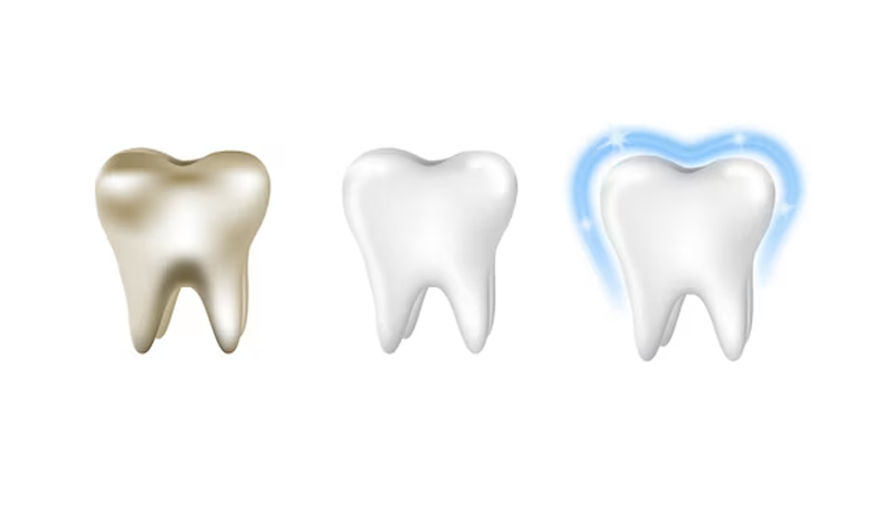The Smile Spa offers both in office whitening and at-home whitening kits. They are easy and convenient. 
